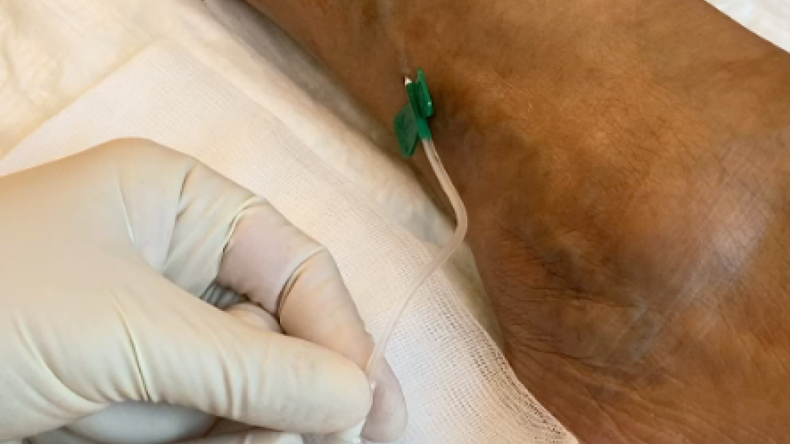 Ultraschallgesteuerte Schaumsklerotherapie